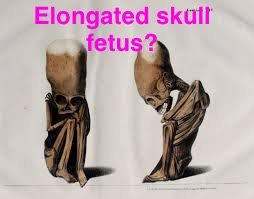 Fetus with Elongated Skull!!??